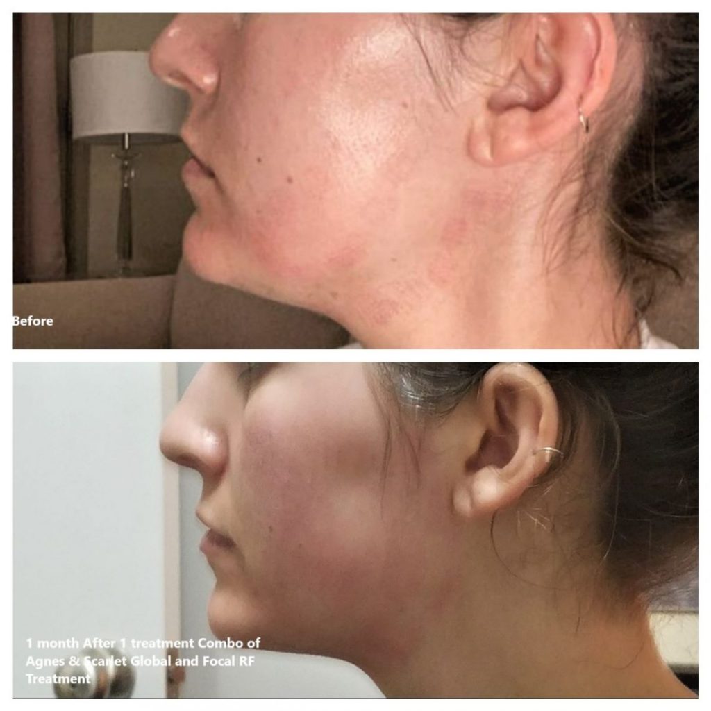 Before after photo of a woman's under-chin area after an Agnes Focal Radio Frequency treatment.