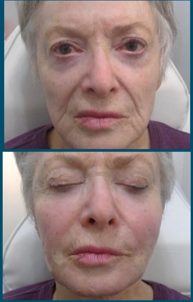 Sculptra Before After of elderly woman's face