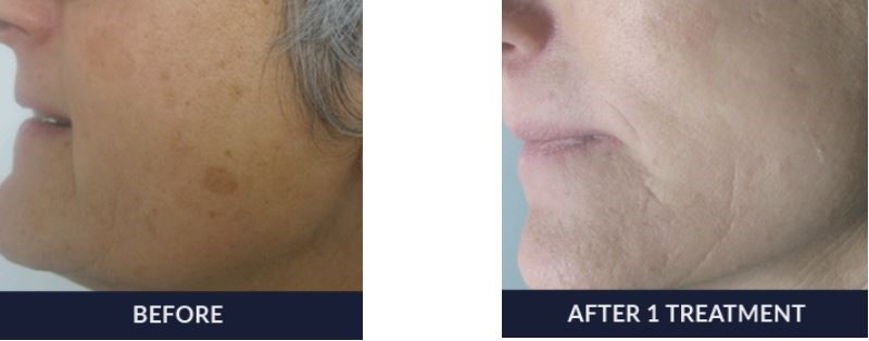 A woman's face before and after an IPL Photofacial treatment - you can clearly see that she has fewer sun spots on her cheek.