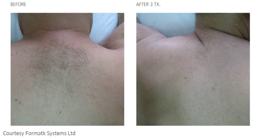 Before and after Laser Hair Removal on a man who had a hair on his back