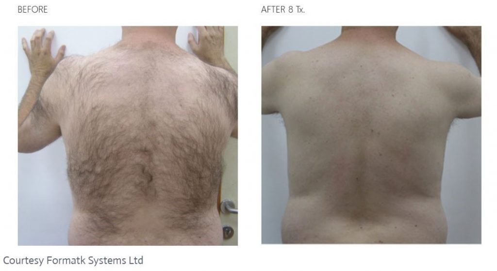 Laser hair shop removal back