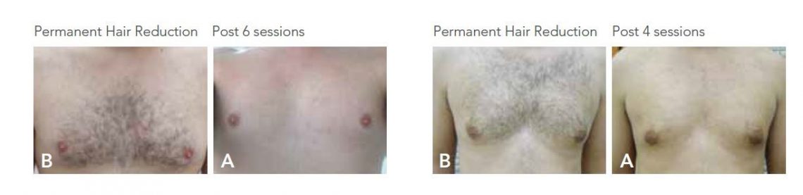 Before and after 6 sessions of Laser Hair Removal on a man who had a a great deal of dark hair on his chest 