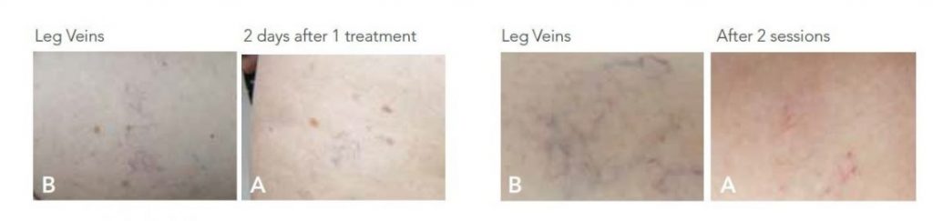 A photo of leg veins before and after IPL Photofacial treatment.