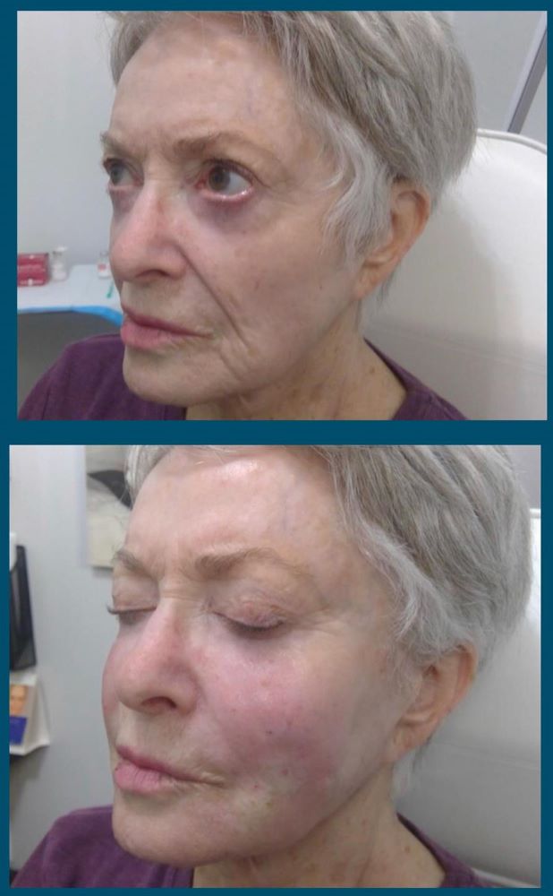 Sculptra before and after side of woman's face