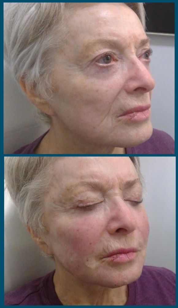 Sculptra liquid facelift before and after