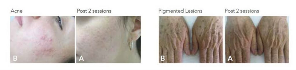 A before and after IPL Photofacial treatment photos of a cheek with acne which clearly demonstrates smoother clearer skin.
