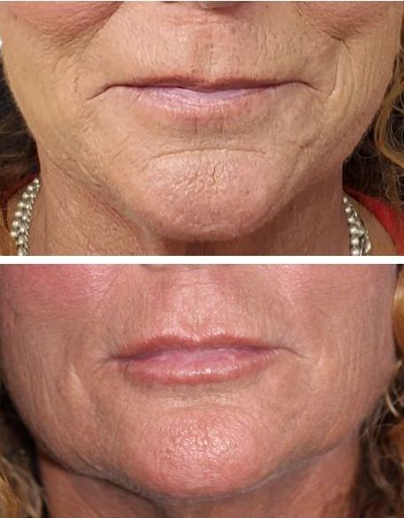 Before After filler lips and chin area
