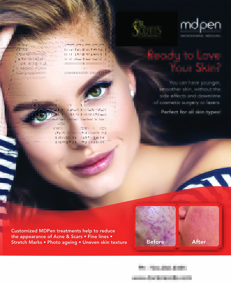 Beautiful woman's face - Ad for Md pen - Dr. Scott's Microneedling Charlotte, NC. Ready to love your skin? You can have younger smoother skin, without the side effects and downtime of cosmetic surgery or lasers.  Perfect for all skin types.  Customized MD Pen treatments help to reduce the appearance of Acne & Scars, fine lines, stretch marks, photo ageing and uneven skin texture.