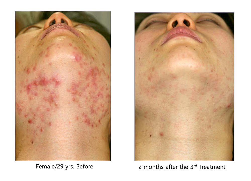 Adult female with acne before and after acne treatment using Agnes  Radio Frequency.