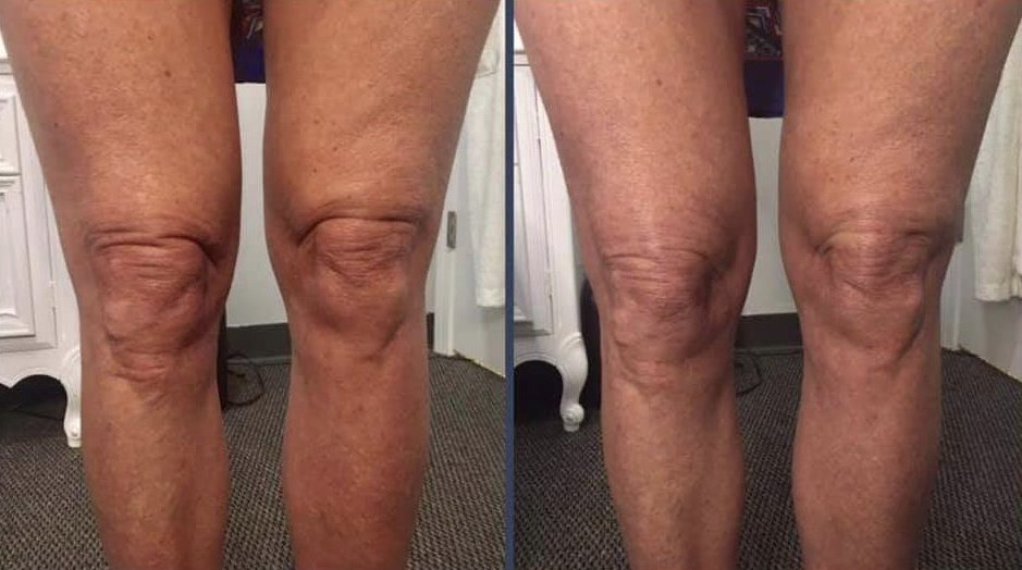 Knees before and after Sculptra