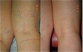 Back of legs with varicose veins - good candidates for sclerotherapy Charlotte.