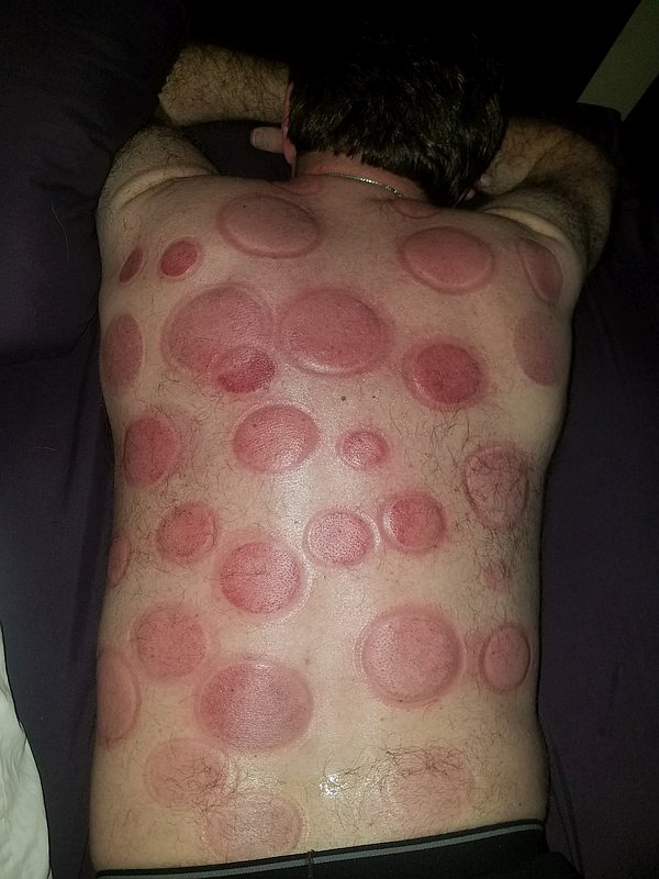 Cupping Therapy Charlotte - Dr. Scott's Restorative Health & Aesthetics