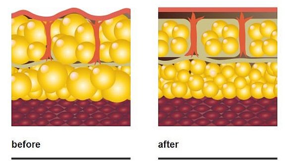 Shock wave therapy results and how it works- before after of cellulite fat.