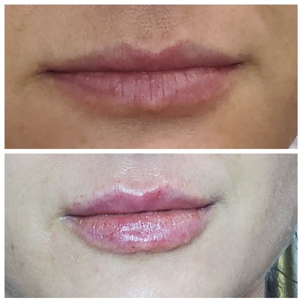 Woman's lips before and after Restylane filler treatment