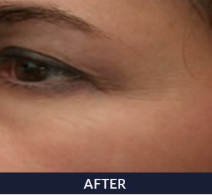Woman after treatment with NeoGen PSR resurfacing.